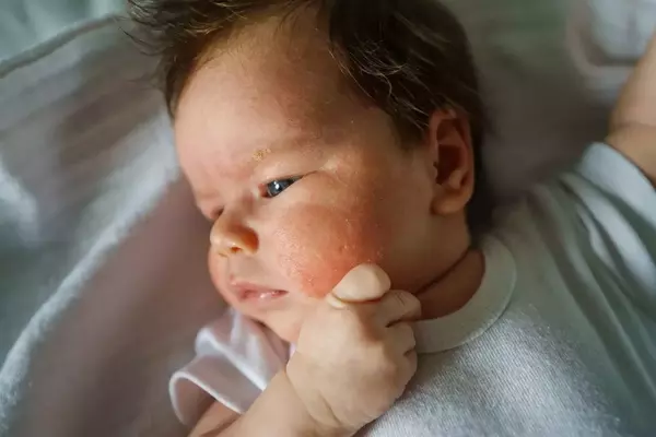 Common Rashes in Children: Identification and Management